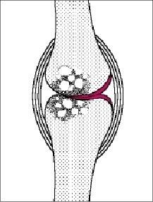 Arthrose intérmédiaire